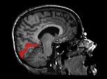 Visual Cortex Reconstruction in a Sagittal MR Slice