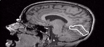 MR Slice Marked with Extracted Region